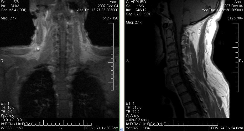 What does your spine MRI report mean