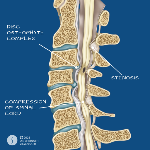 Cervical Disc Disease