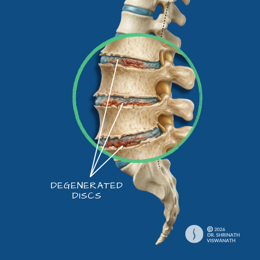 Degenerative Disc Disease