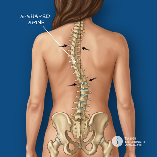 Spinal deformity scoliosis illustration