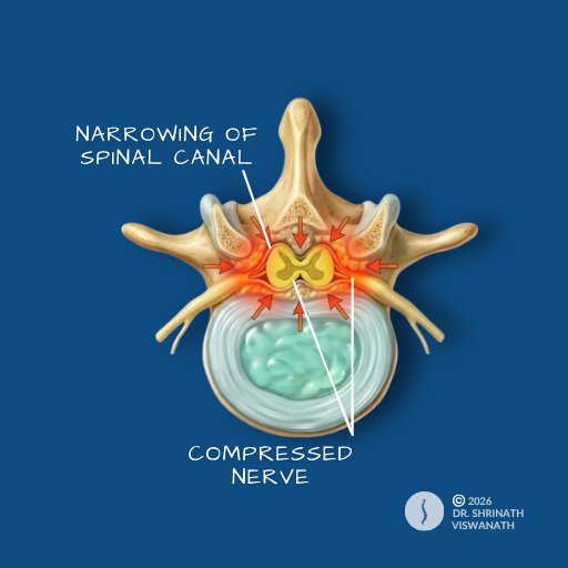 Spinal Stenosis