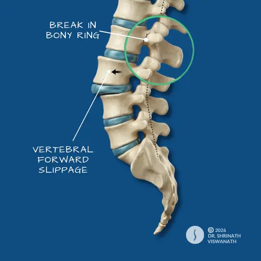 Spondylolisthesis