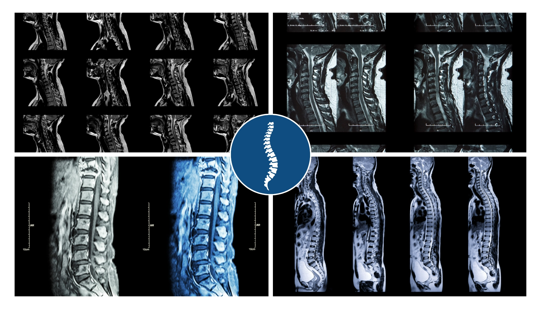 Cross-sectional spine MRI report view of lumbar spine showing intervertebral discs and vertebral bodies — used to illustrate spinal imaging findings discussed by Dr. Shrinath Viswanath.